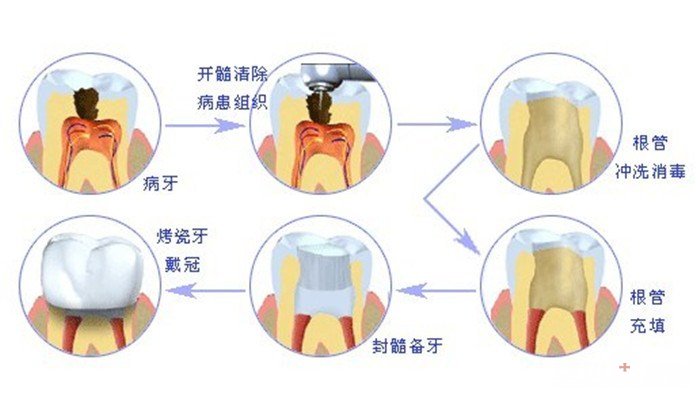 此图为牙髓炎的治疗过程